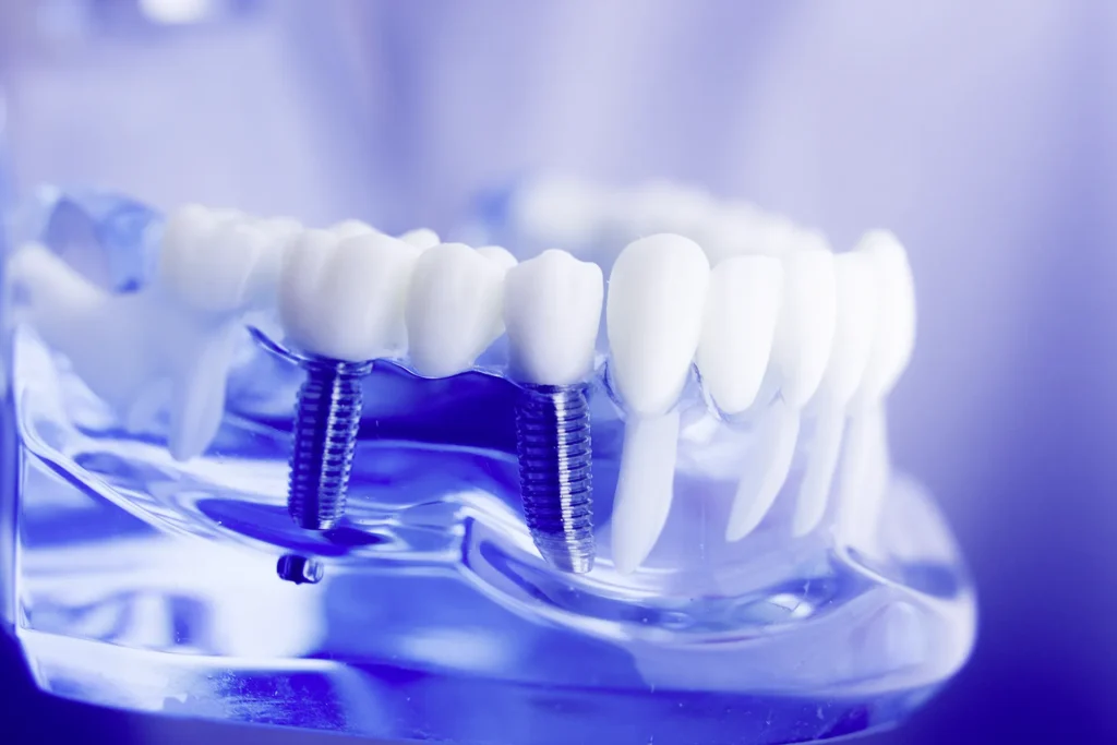 Zahnimplantante in der Zahnarztpraxis Bergstedt