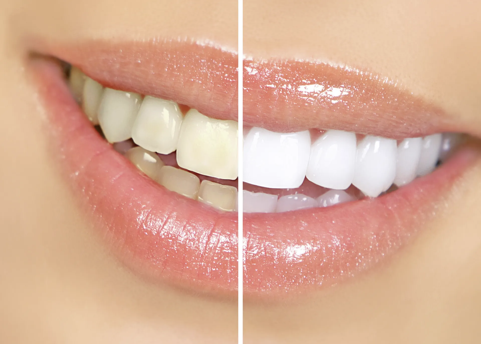 Bleaching & Veneers